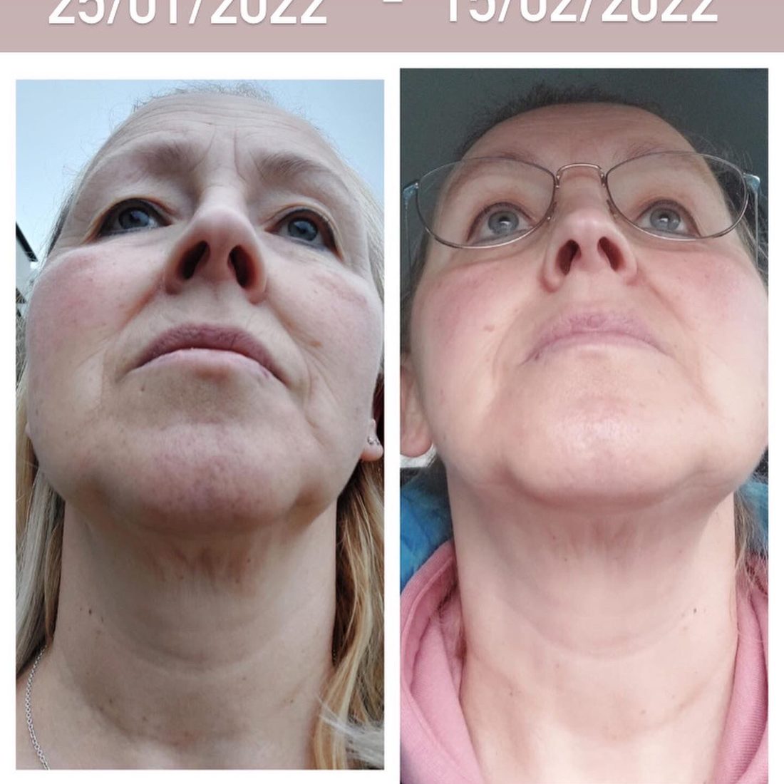 Voor en na Collagen Elixir™, hals van een vrouw, 25 januari en 15 februari 2022