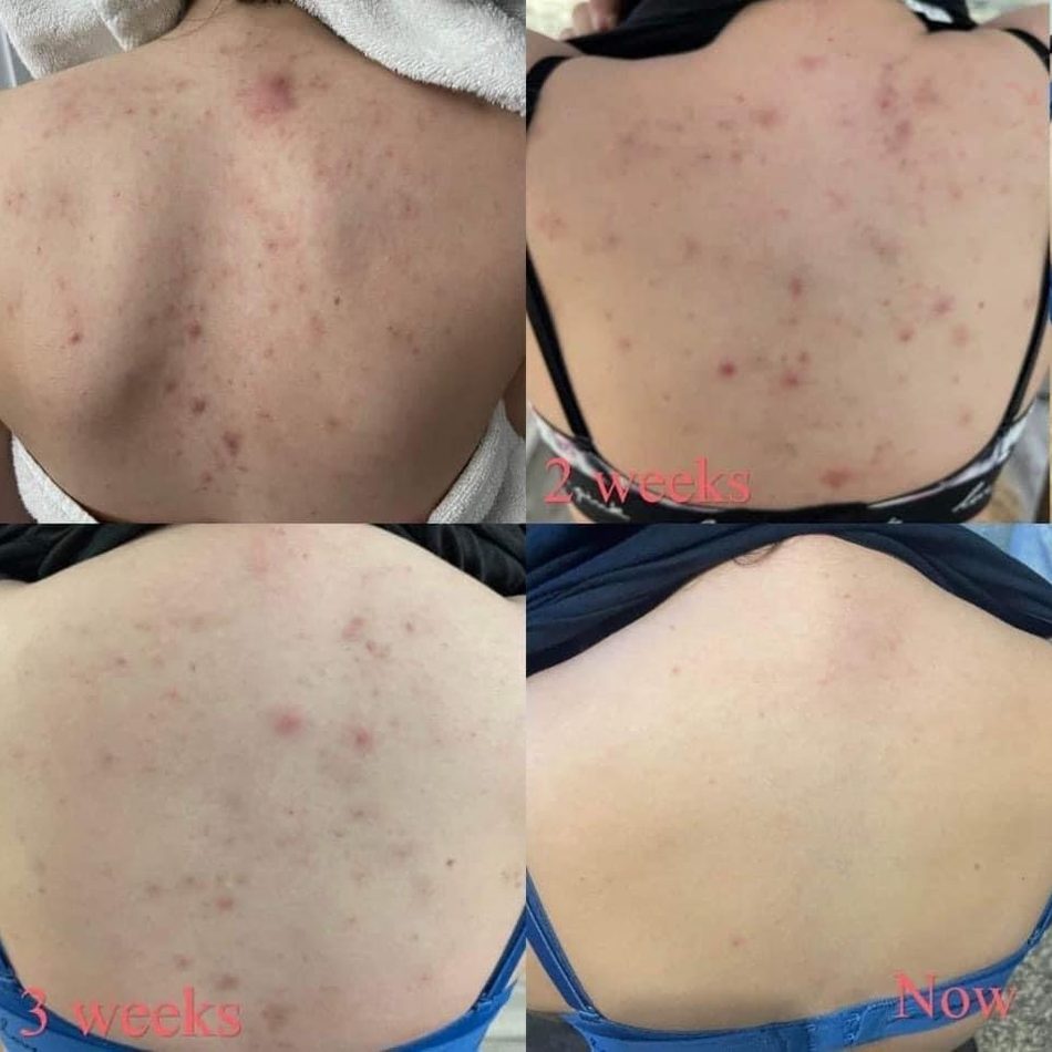 Voor en na Collagen Elixir™, rug van een vrouw na 2 en 3 weken en nu
