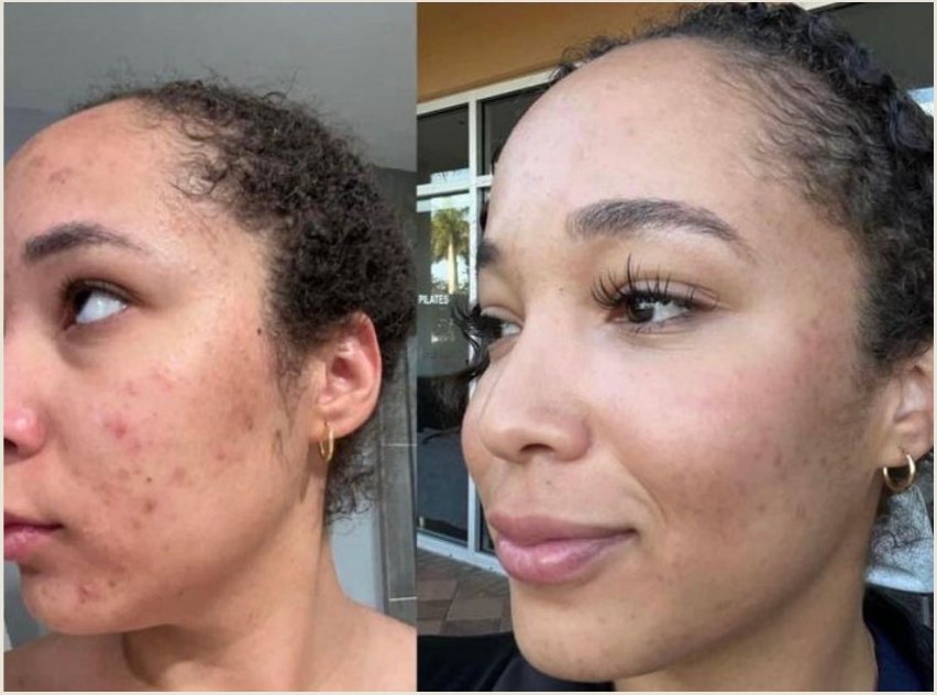 Voor en na Collagen Elixir™, gezicht van een vrouw met acne van opzij