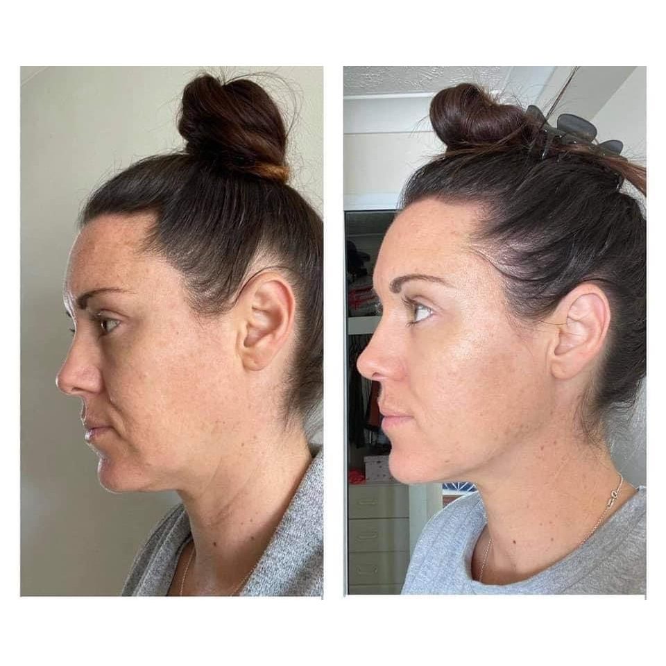 Voor en na Collagen Elixir™, gezicht en kaaklijn van een vrouw van opzij