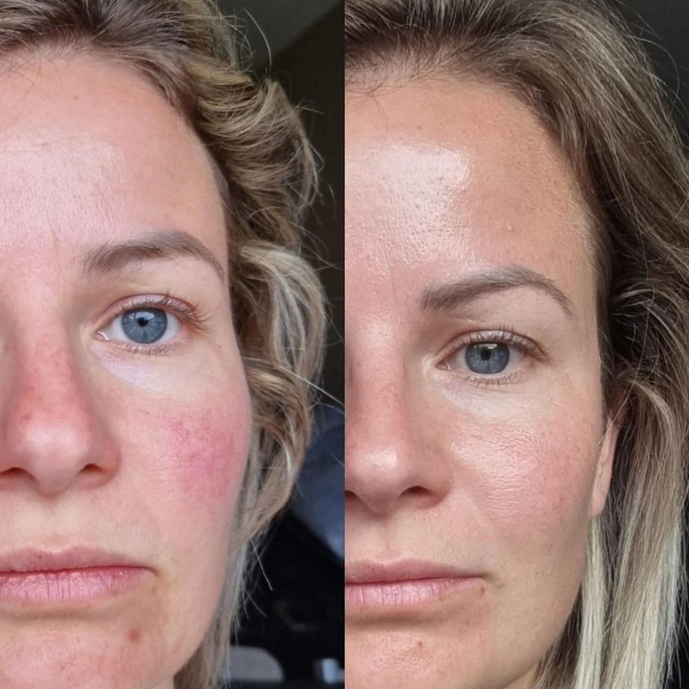 Voor en na Collagen Elixir™, gezicht van een blonde vrouw van voren