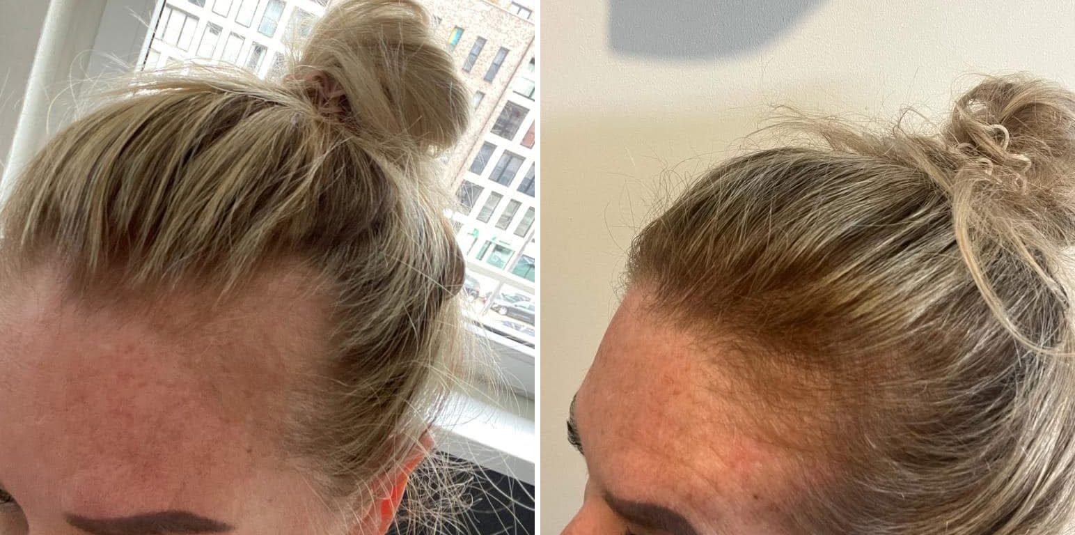 Voor en na Collagen Elixir™, haarlijn van een blonde vrouw met knot