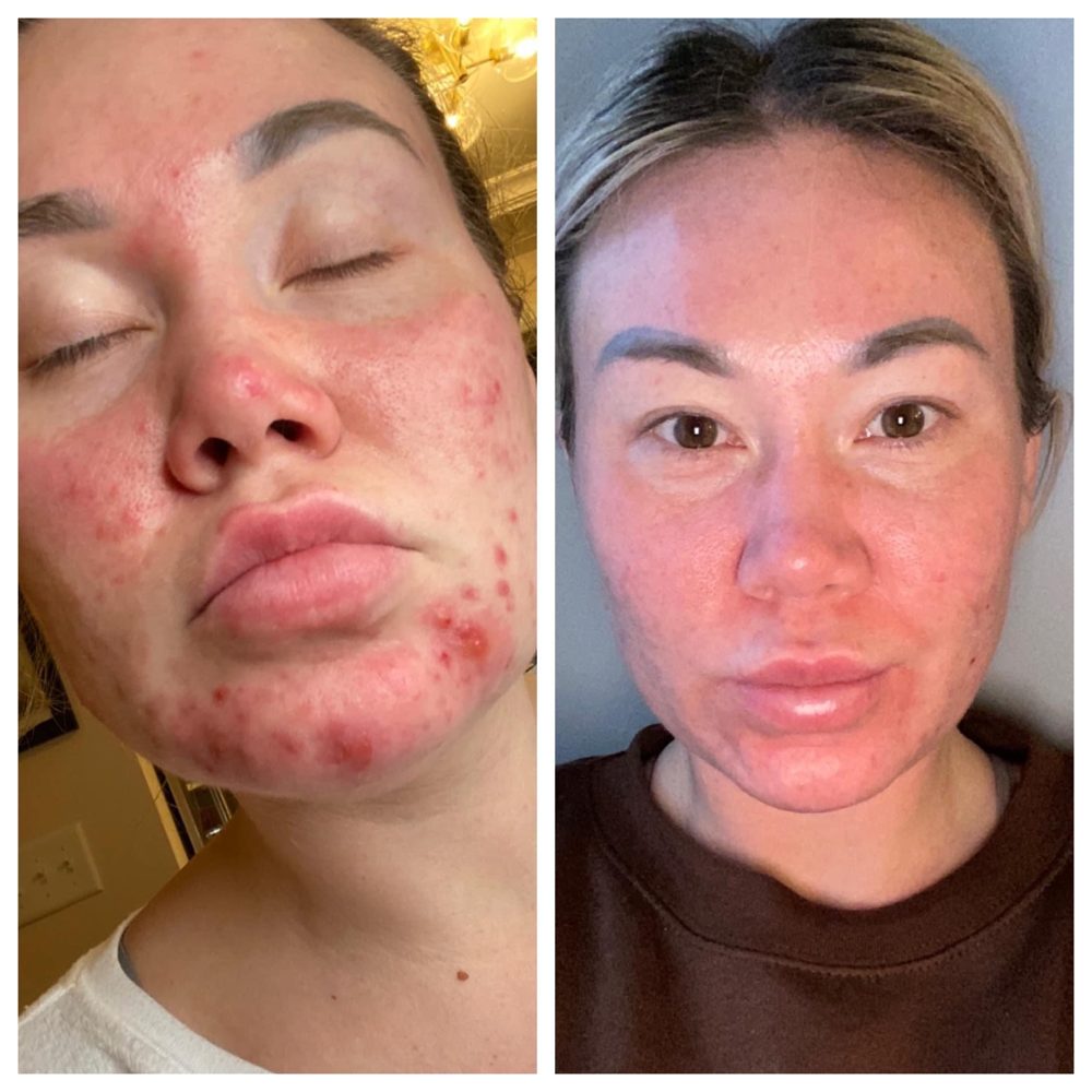 Voor en na Collagen Elixir™, gezicht van een vrouw met acne