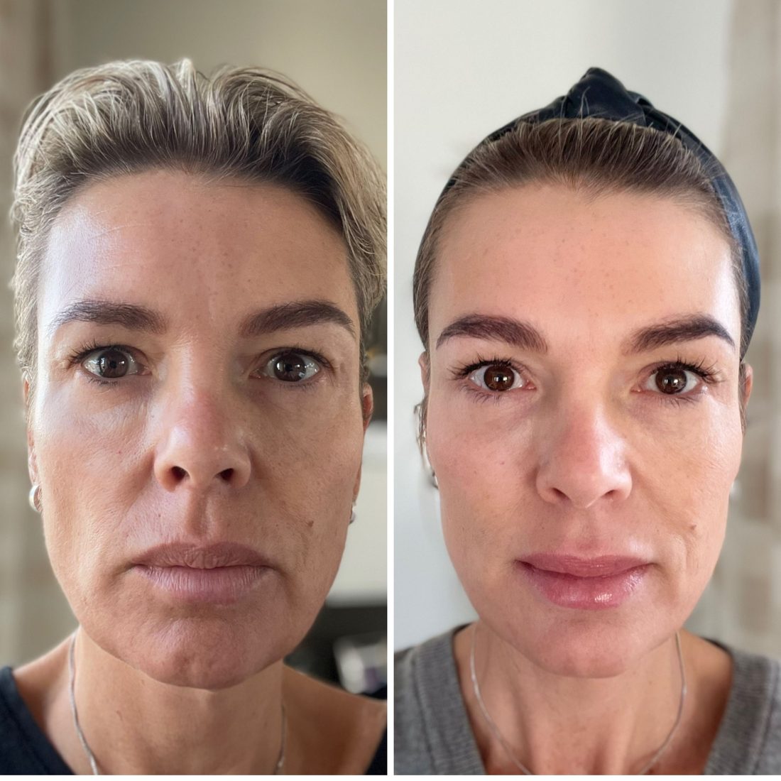 Voor en na Collagen Elixir™, gezicht van een vrouw na 30 flesjes