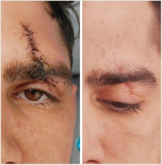 Voor en na Collagen Elixir™, litteken bij de wenkbrauw van een man