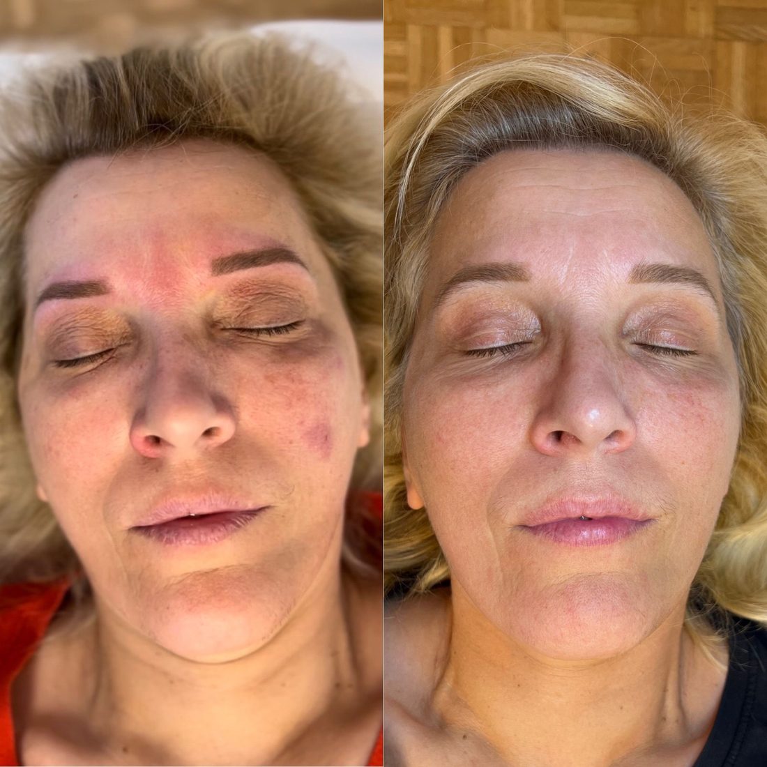 Voor en na Collagen Elixir™, gezicht van een vrouw van voren