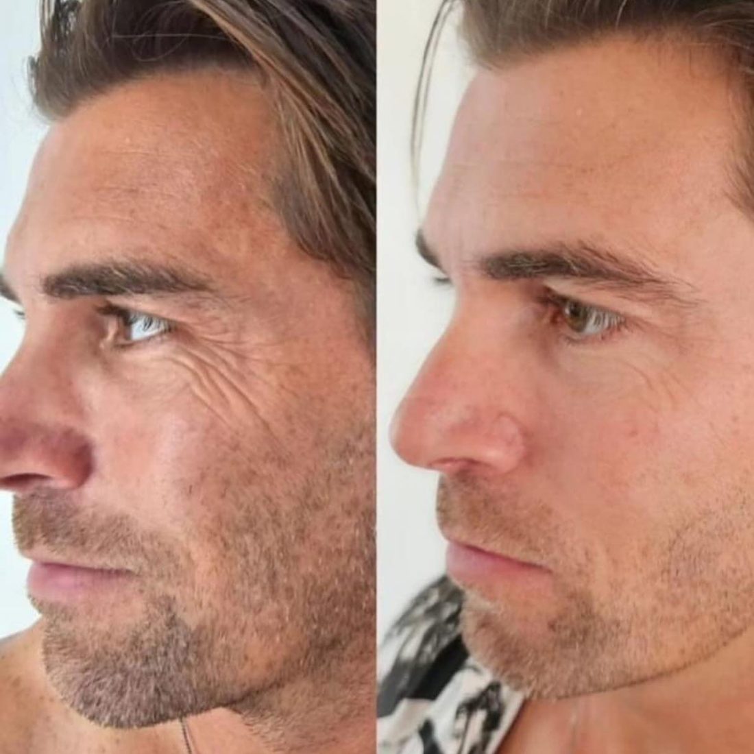 Voor en na Collagen Elixir™, gezicht van een man van opzij