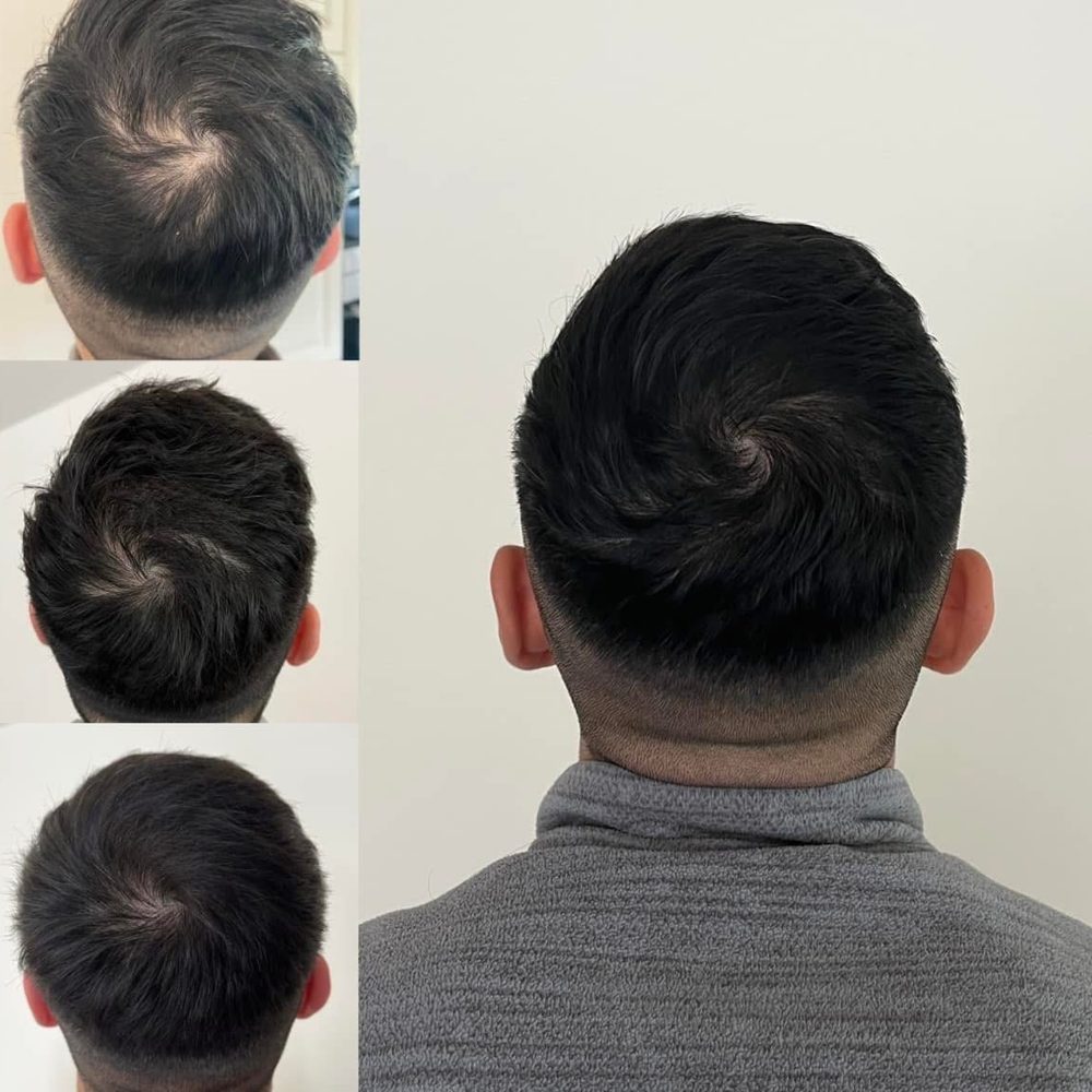 Voor en na Collagen Elixir™, kruin van een man