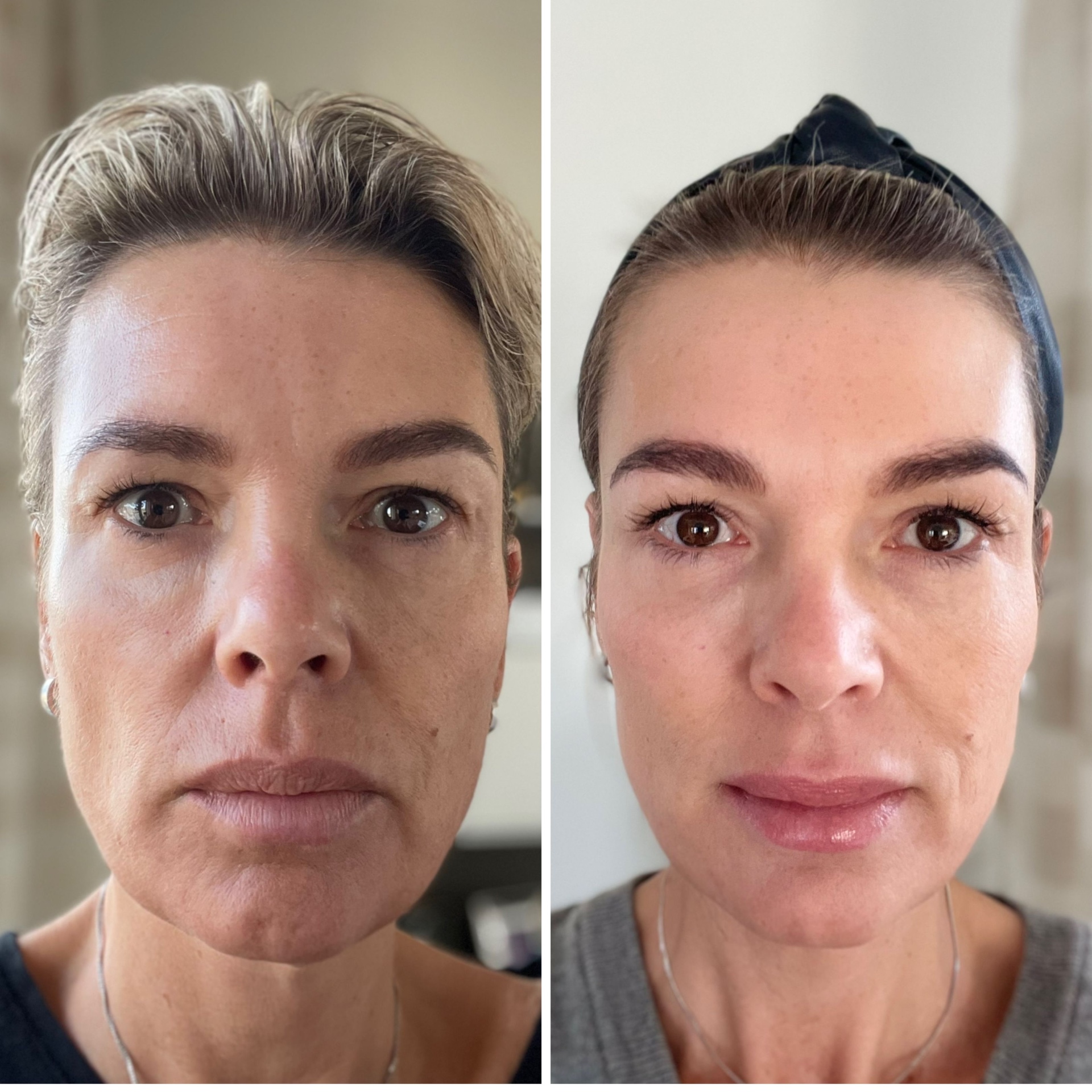 Ilse voor en na 30 flesjes Collagen Elixir™, gezicht van voren