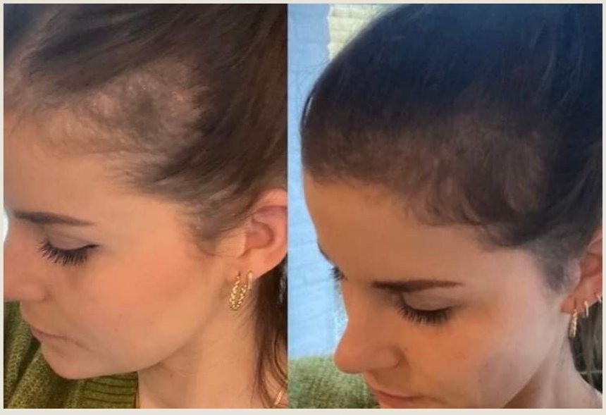 Voor en na Collagen Elixir™, haarlijn van een vrouw met donker haar