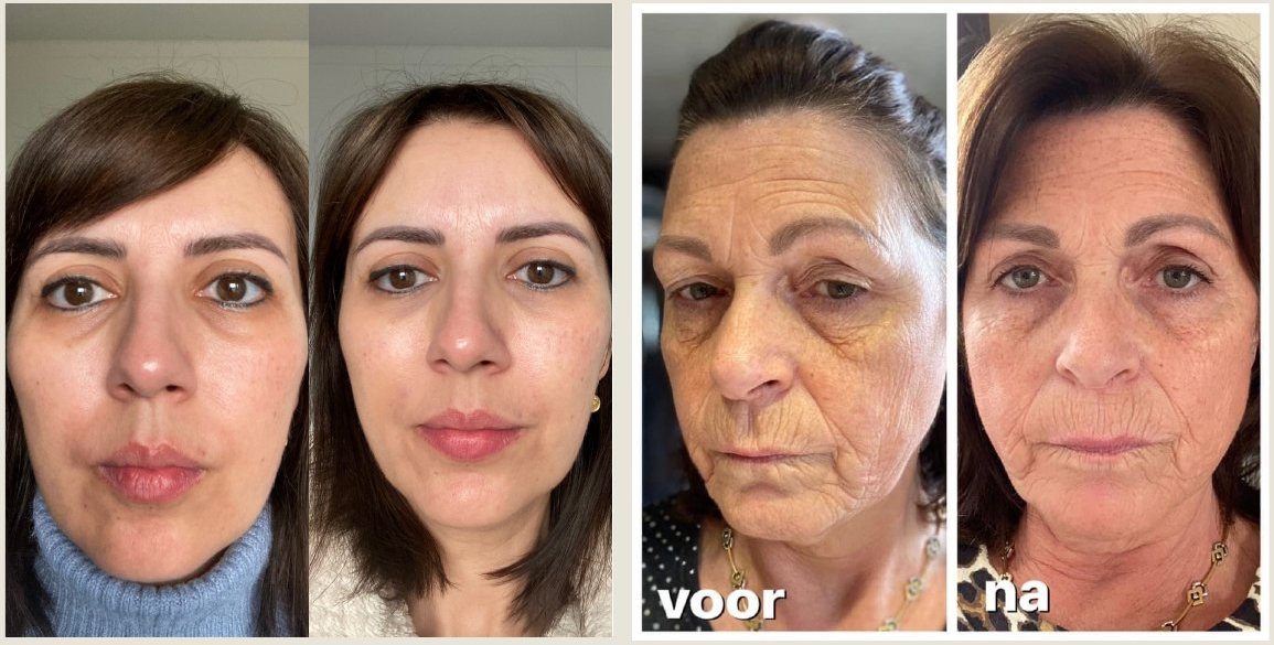 Voor en na Collagen Elixir™, twee vrouwen, huid rond de ogen