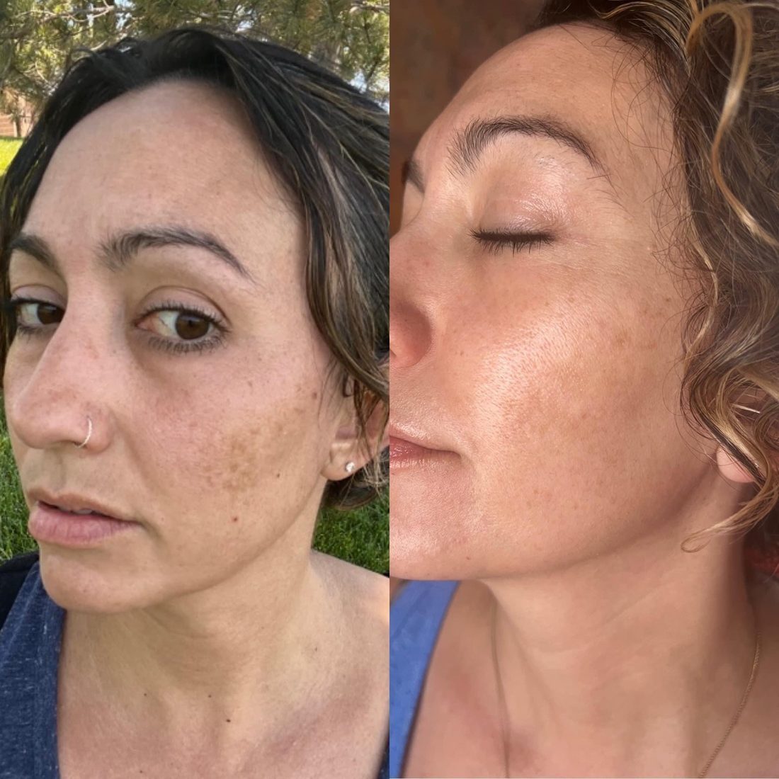 Voor en na Collagen Elixir™, huid van een vrouw met donker krullend haar