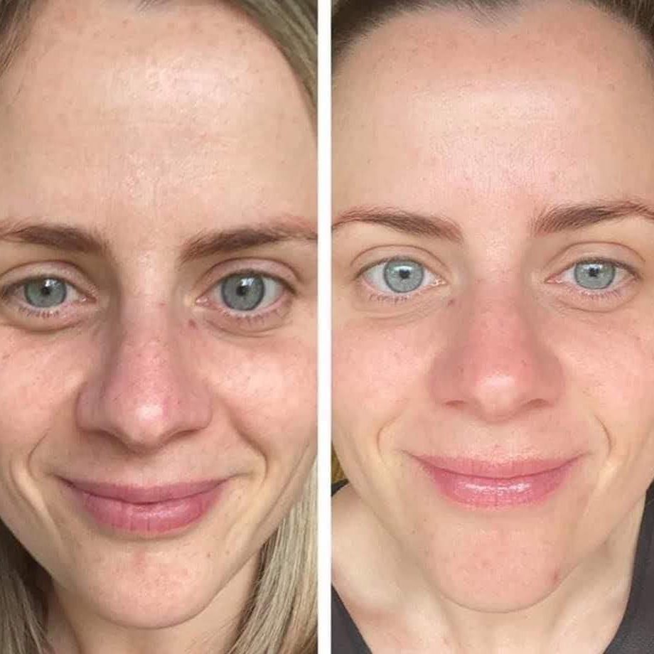 Voor en na Collagen Elixir™, glimlachende vrouw met blauwe ogen