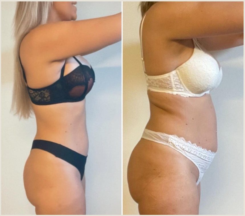 Voor en na Body Reset, vrouw van opzij