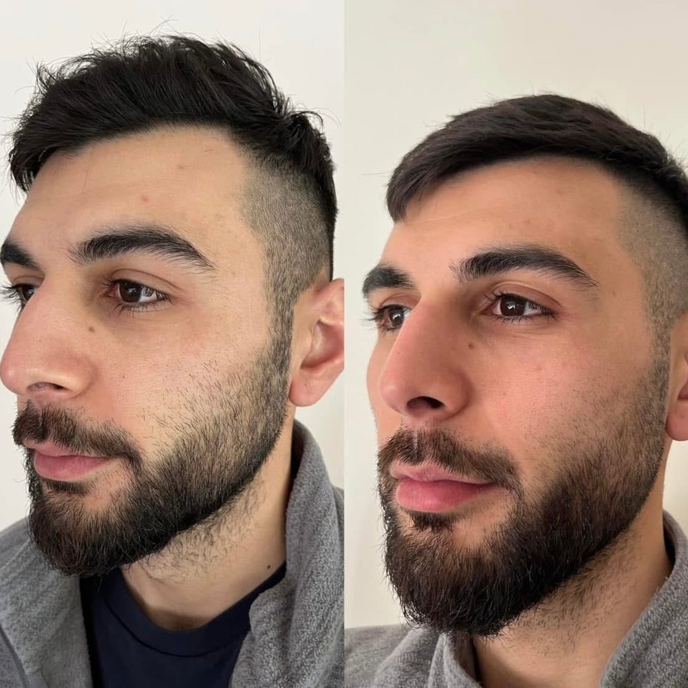 Voor en na Collagen Elixir™, gezicht van een man van opzij
