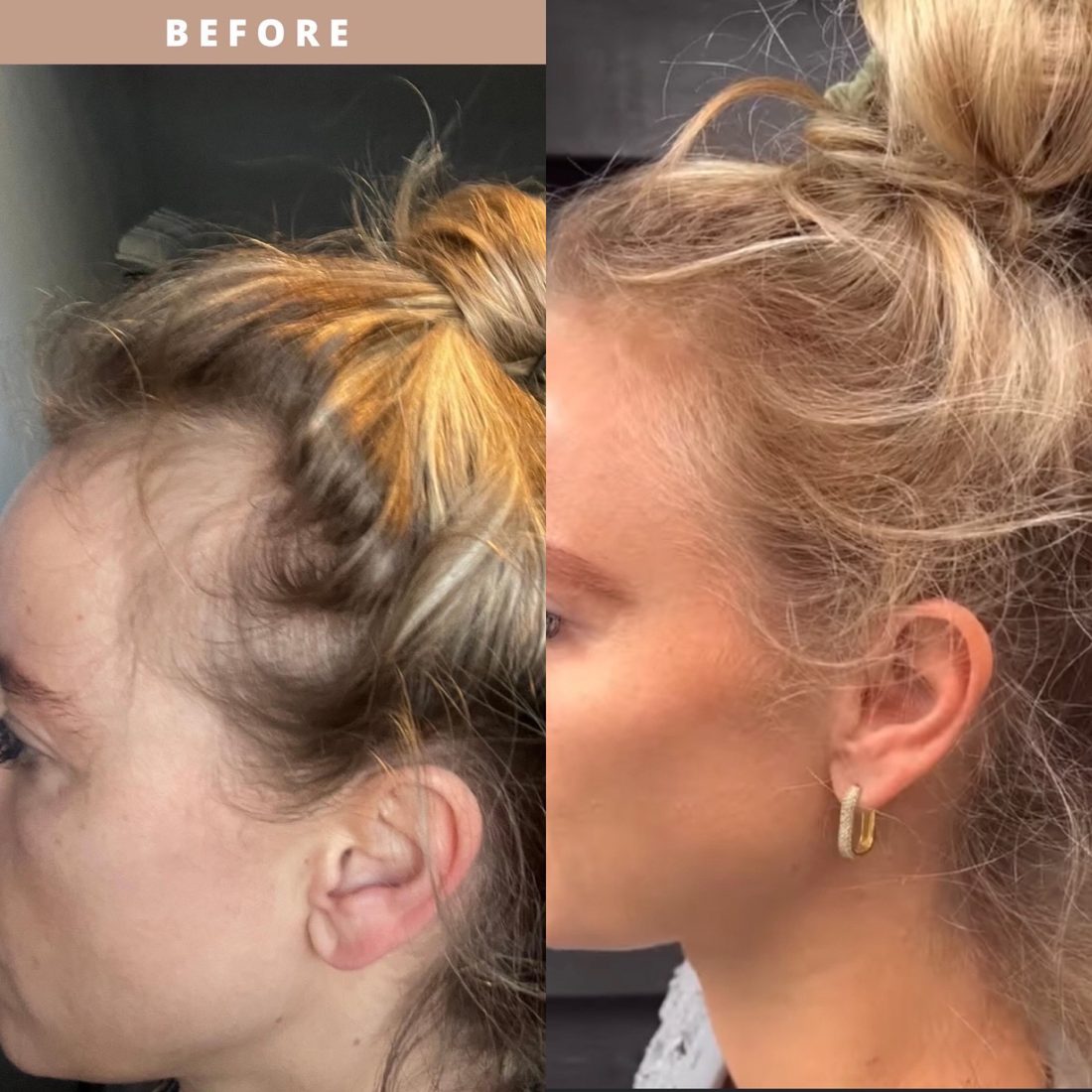Voor en na Collagen Elixir™, haarlijn van een blonde vrouw