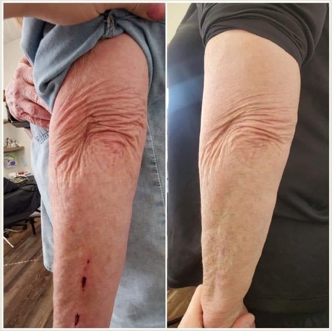Voor en na Collagen Elixir™, huid van een arm