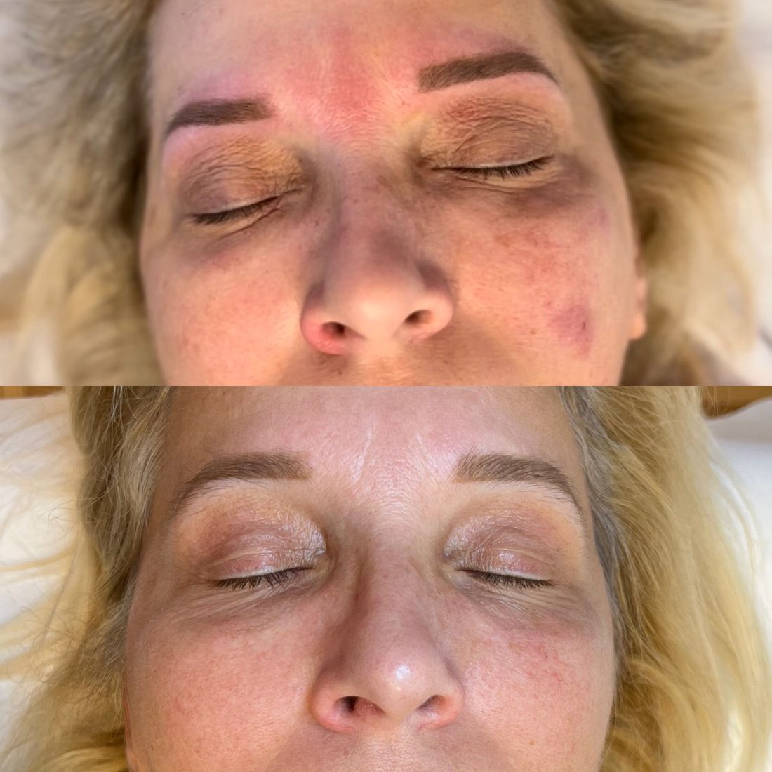 Voor en na Collagen Elixir™, gezicht van een vrouw met gesloten ogen