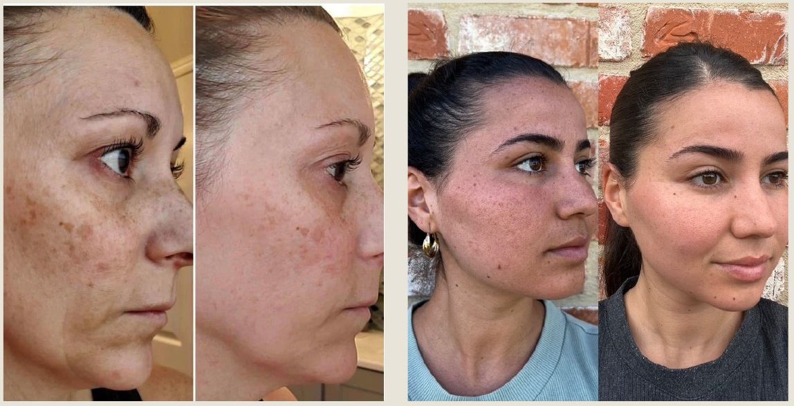 Voor en na Collagen Elixir™, twee vrouwen met pigmentvlekken
