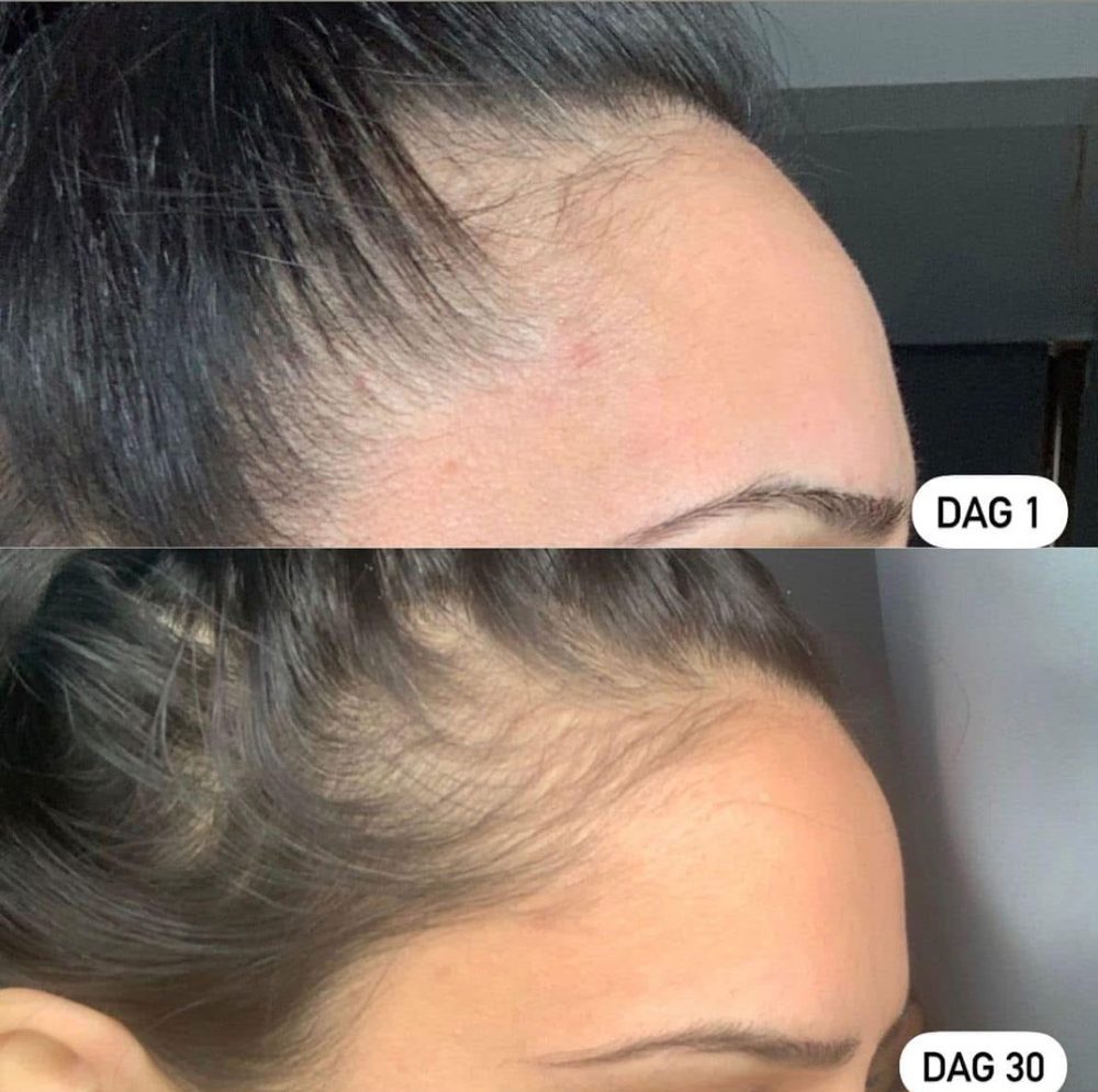 Voor en na Collagen Elixir™, haarlijn van een vrouw op dag 1 en dag 30