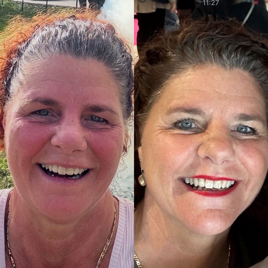 Voor en na Collagen Elixir™, lachende vrouw