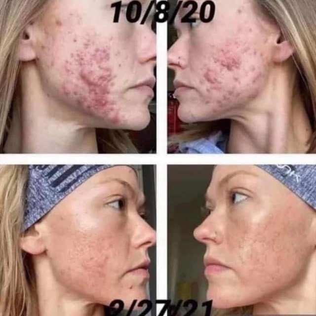 Voor en na Collagen Elixir™, gezicht van een vrouw met acne, oktober 2020 en februari 2021